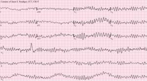 Diagnosing it is critical, as arrhythmia can indicate severe heart damage. Arrhythmia Wikipedia