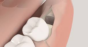 16 wann darf man nach der weisheitszahn op rauchen? Weisheitszahnentfernung Praxis Dr Dr Jorg Heine Kollegen