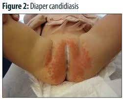 Image result for diaper dermatitis