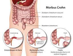 Morbus Crohn Neue Behandlungsoption Bei Chronischen Darmentzundungen Heilpraxis