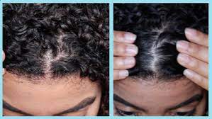 Use raw apple cider vinegar this is sooooo important, but the apple cider vinegar needs to be raw with the mother acv. How To Remove Dandruff With Apple Cider Vinegar Natural Curly Hair Youtube