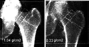 X Ray Absorption Images Of Bone Brighter Image On Left