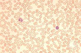 Prca arises when damage occurs to the bone marrow, where it is unable to produce a sufficient amount of red blood cells. Pure Red Cell Aplasia Prca Parvovirus Infection 1