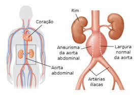 Meu estômago está pulsando, o que pode ser? Saude E Vida Sobre O Aneurisma De Aorta Abdominal Por Facebook