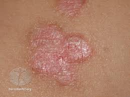 Image result for Intertrigo under breasts