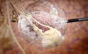 Tumors To Meet A Frozen End At Private Haifa Hospital Medical Technology Medication Management Medical