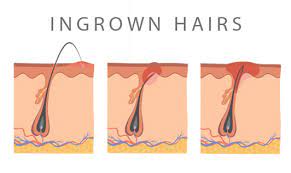 Difference between a pimple and an ingrown hair. How Long Do Ingrown Hairs Last Top Useful Ways To Remove Them