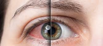 This happens due to an insufficient amount of oxygen. Most Common Causes Of Bloodshot Eyes Feel Good Contacts Uk