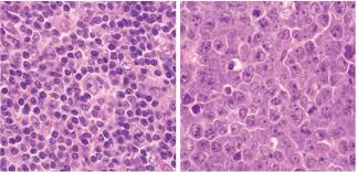 Histologically, it is characterized by a unique tumor. Angioimmunoblastic T Cell Lymphoma An Epstein Barr Virus Associated Bilineage Lymphoid Neoplasm Asian Archives Of Pathology