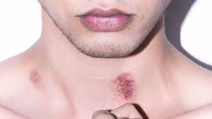 How To Get Rid Of A Hickey, If You Somehow Are Still Getting Hickeys |  British Gq | British Gq
