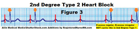 Check spelling or type a new query. How To Tell The Difference Between Av Heart Blocks 1 Degree Wenckebach Mobitz Ii Third Degree