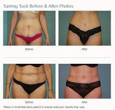 With advanced surgical techniques, your body contour can be refined, reshaped, and enhanced. Abdominoplasty Las Vegas Dr Arthur Cambeiro