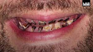 Depending on the severity of your cavities. Dentist Fixes Rotten Teeth For Free Youtube