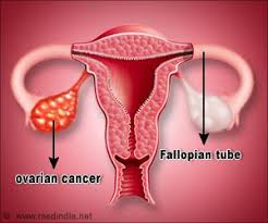 Ovarian cancer is when abnormal cells in the ovary begin to multiply out of control and form a tumor. Early Ovarian Cancer Can Be Detected By A Simple Test