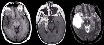 Rasmussen's encephalitis is a progressive hemispheric atrophy of unknown origin. Herpes Encephalitis
