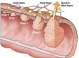 Colorectal Cancer Gateway Clinics Coimbatore Gateway Clinics Coimbatore Learn more about this stage, where it spreads, treatment options and questions to ask your doctor.