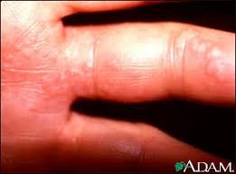 Rather it could be either due to some allergic reaction or a low platelet count. Herpes Zoster Shingles On The Hand And Fingers Medlineplus Medical Encyclopedia Image
