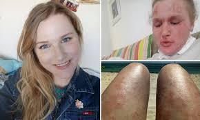 This medicine may affect growth in children and teens in some cases. Perth Woman With Eczema Claims Topical Steroids Caused Her Hair To Fall Out And Left Skin Blistering Daily Mail Online