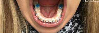 1 of transparent aligners for thousands of dentists and orthodontists. Adult Braces Update 3 Foods To Avoid