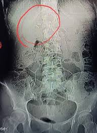 Image result for Incidental Imaging Finding