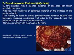 Classification 1 Pseudomyxoma Peritonei Pmp Contains Benign Or Borderline Epithelial Cells Or Cells From Well Differ Health Disease Cavities