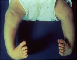 Image result for Clubfoot