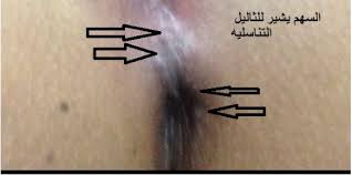 فيروس الورم الحليمي البشري dr bernard kassab