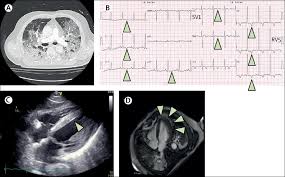 When present, signs and symptoms may include chest pain, abnormal heartbeat, shortness of breath, fatigue, signs of infection (i.e. Myocarditis In A Patient With Covid 19 A Cause Of Raised Troponin And Ecg Changes The Lancet