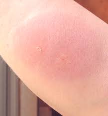 Pin On Insect Sting Allergy