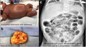 Image result for Necrotizing Enterocolitis