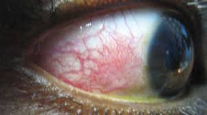 Image result for Gonococcal Conjunctivitis
