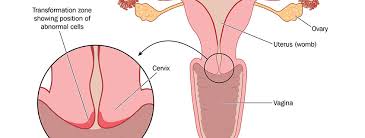 The decision to have radiation therapy is often very personal, explained dr. Cervical Cancer And Uterine Body Cancer What Is The Difference