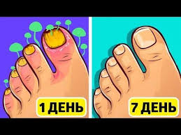 как избавиться от грибка на ногах в домашних условиях Gribok Nogtej Ischeznet Navsegda S Pomoshyu Etogo Domashnego Sredstva Youtube Domashnie Sredstva Zdorove Alternativnaya Medicina