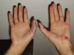 I broke it 2 weeks before i went to the doctor she also tripped the shutter for this picture as my remote battery is dead. Broken Thumb I Was Supposed To Buy The Bike Not Fall Off Flickr