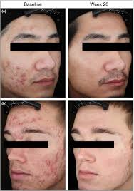 Isotretinoin is a form of vitamin a that is used to treat severe nodular acne that has not responded to other treatments, including antibiotics. 4ej J Qxlxtkam