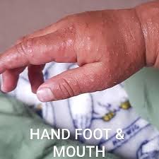 What is hand, foot, and mouth (hfmd) disease? Hand Foot And Mouth Disease Babycenter