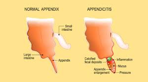 9 Appendicitis Symptoms You Should Know According To Doctors In 2020 Appendicitis Symptoms Pelvic Inflammatory Disease Medical Prescription