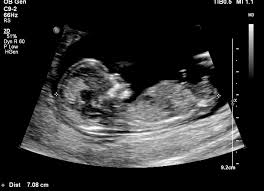 Nuchal Translucency Crl