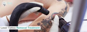 Laser Tattoo Removal In Gurgaon Permanent Tattoo Removal Clinic Cost In Gurgaon