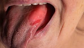 Image result for brown tongue symptoms
