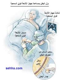 الحبن 4