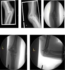 Image result for Lateral Condyle Fracture