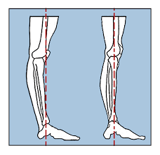 If u heard a small pop most likely u hyperextended the knee. Hyperextension The Good The Bad And The Ugly Dance Workshop North Perth