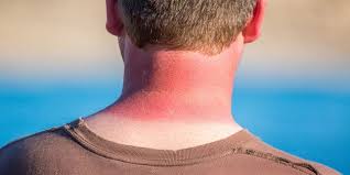 It's really important that you follow these guidelines to minimize sun damage: Getting Really Bad Sunburns As A Teen Could Raise Skin Cancer Risk Huffpost Life