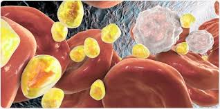 Image result for Hypertriglyceridemia