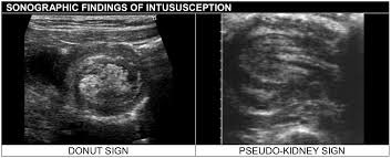 Image result for Intussusception