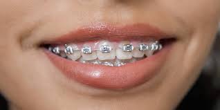 The stains will form and when you'll remove your braces at that time it'll be very difficult for you to remove those i think you mean, how can you move the stains from the teeth with braces on. 5 Life Changing Tips Keep Your Ceramic Braces Stain Free