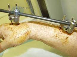 We did not find results for: Broken Arm Second Fix