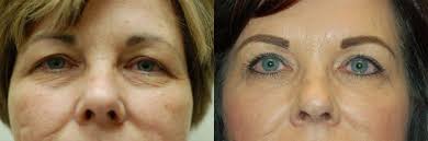 Welcome to fleming island surgery center! Blepharoplasty Jacksonville Fl Fleming Island Blepharoplasty