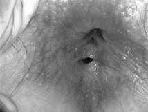 Image result for anal fistula